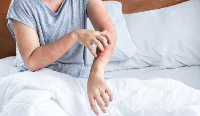 Woman rubbing her hand due to an allergic reaction